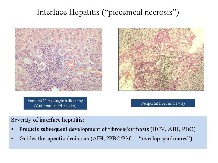 Interface Hepatitis (“piecemeal necrosis”) Periportal hepatocyte ballooning (Autoimmune Hepatitis) Periportal fibrosis (HVG) Severity of