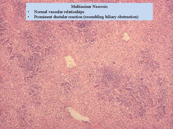  • • Multiacinar Necrosis Normal vascular relationhips Prominent ductular reaction (resembling biliary obstruction)