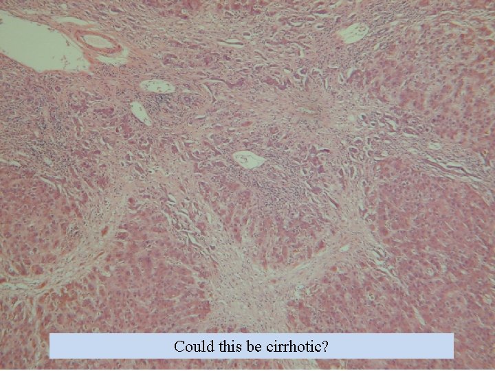 Could this be cirrhotic? 