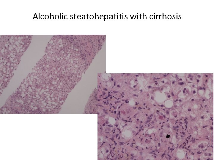 Alcoholic steatohepatitis with cirrhosis 