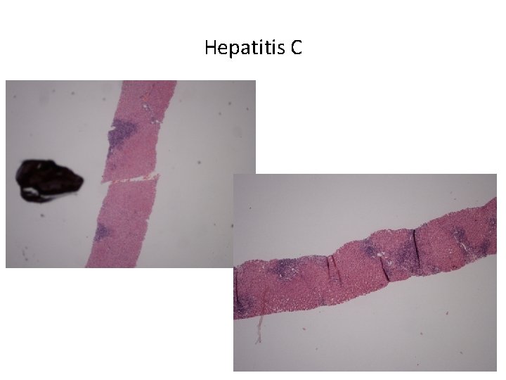 Hepatitis C 