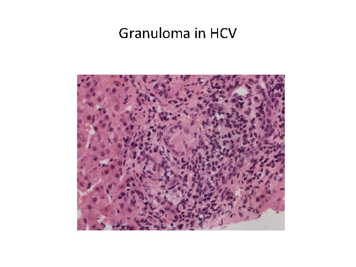 Granuloma in HCV 