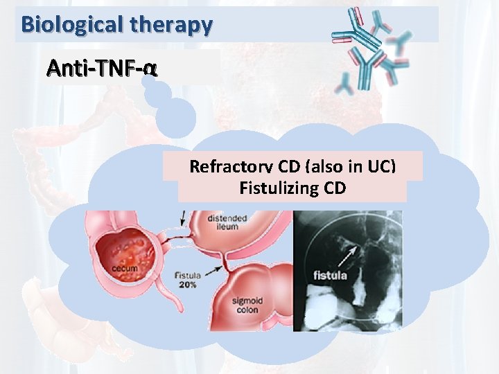 Biological therapy Anti-TNF-α Refractory CD (also in UC) Fistulizing CD 