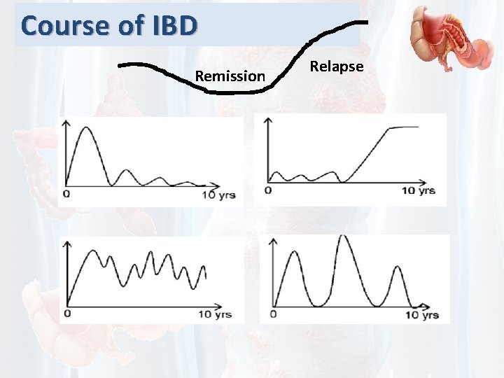 Course of IBD Remission Relapse 
