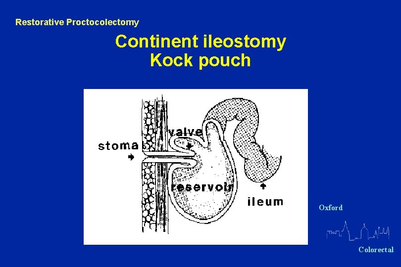 Restorative Proctocolectomy Continent ileostomy Kock pouch Oxford Colorectal 