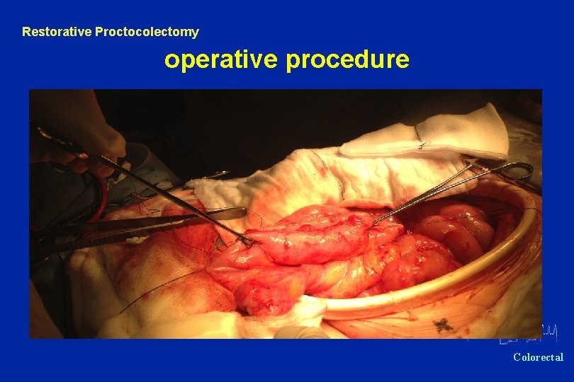 Restorative Proctocolectomy operative procedure Oxford Colorectal 