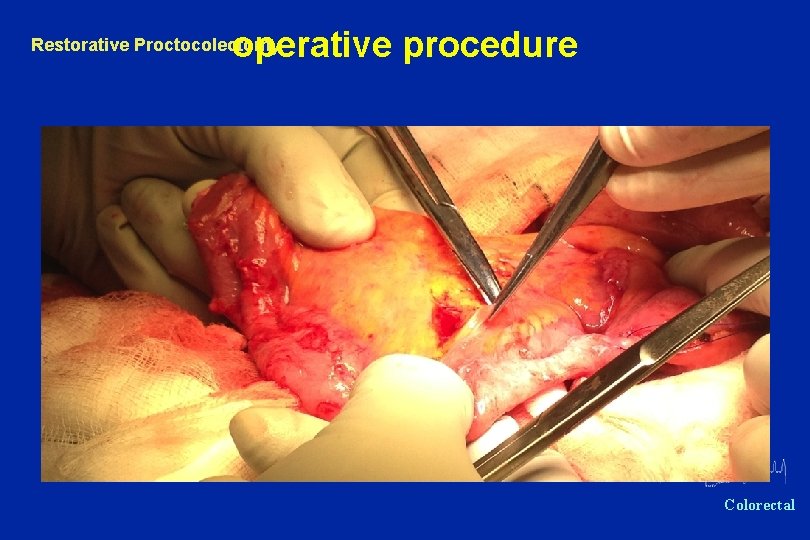 operative procedure Restorative Proctocolectomy Oxford Colorectal 