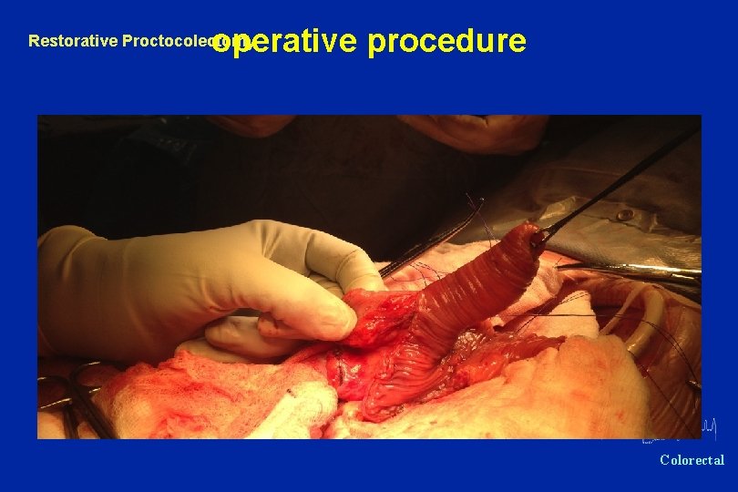 operative procedure Restorative Proctocolectomy Oxford Colorectal 