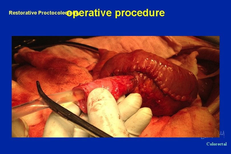 operative procedure Restorative Proctocolectomy Oxford Colorectal 