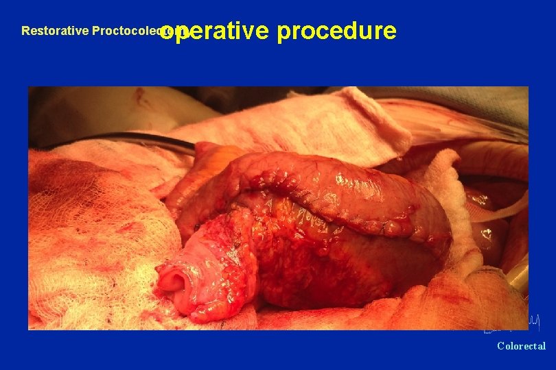 operative procedure Restorative Proctocolectomy Oxford Colorectal 