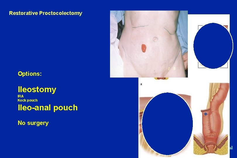 Restorative Proctocolectomy Kangaroo Club Information Day Bruce