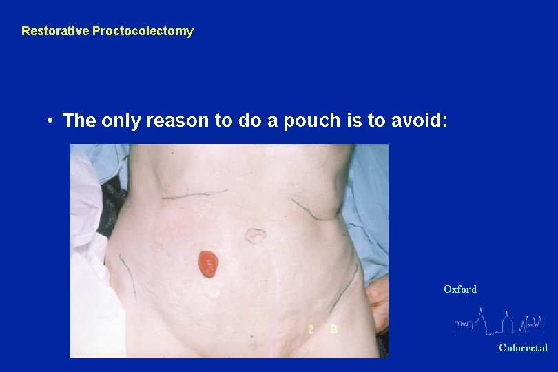 Restorative Proctocolectomy • The only reason to do a pouch is to avoid: Oxford
