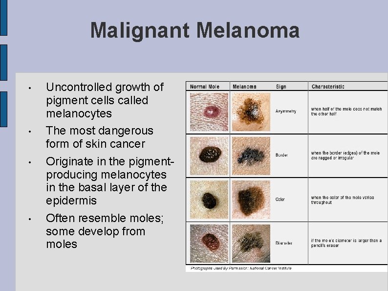 Malignant Melanoma • • Uncontrolled growth of pigment cells called melanocytes The most dangerous