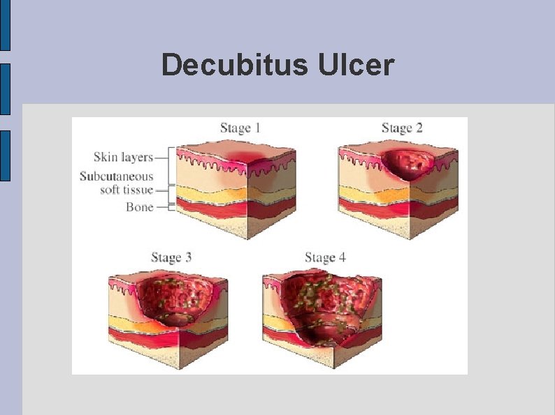 Decubitus Ulcer 