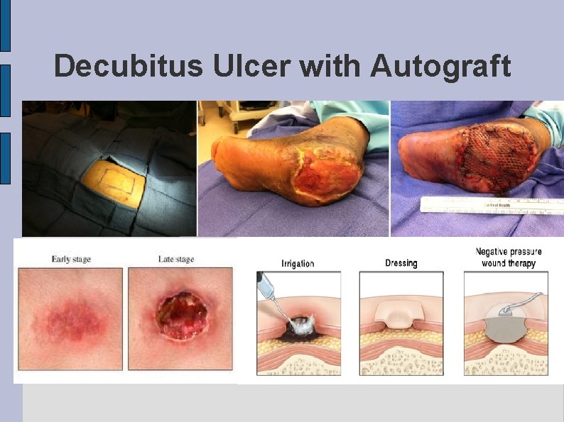 Decubitus Ulcer with Autograft 