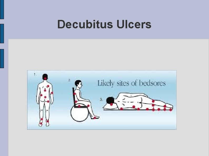 Decubitus Ulcers 