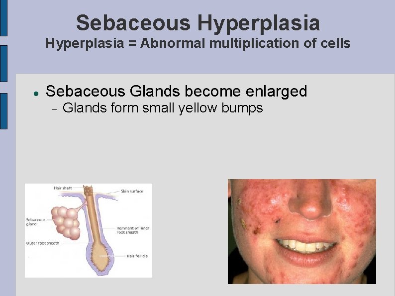 Sebaceous Hyperplasia = Abnormal multiplication of cells Sebaceous Glands become enlarged Glands form small