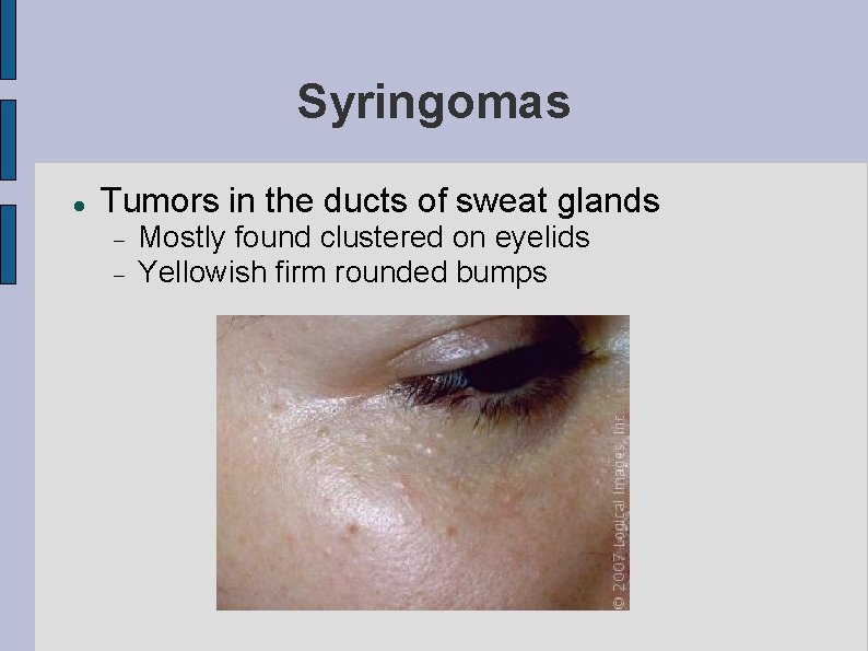 Syringomas Tumors in the ducts of sweat glands Mostly found clustered on eyelids Yellowish