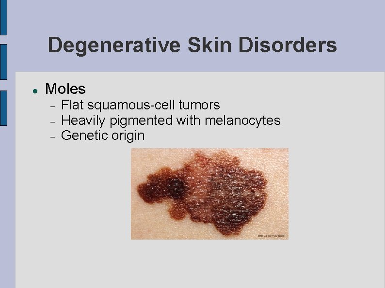 Degenerative Skin Disorders Moles Flat squamous-cell tumors Heavily pigmented with melanocytes Genetic origin 