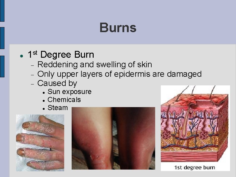 Burns 1 st Degree Burn Reddening and swelling of skin Only upper layers of