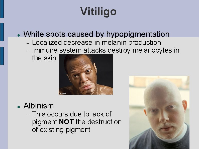 Vitiligo White spots caused by hypopigmentation Localized decrease in melanin production Immune system attacks