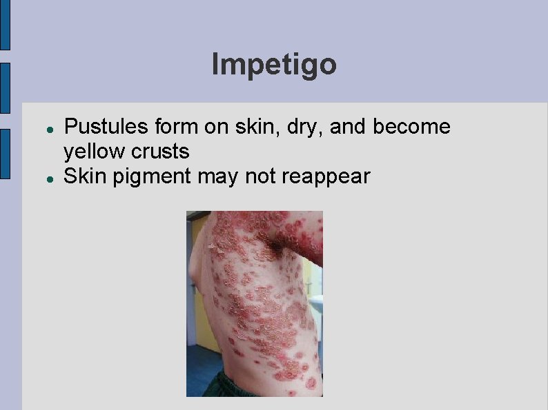 Impetigo Pustules form on skin, dry, and become yellow crusts Skin pigment may not