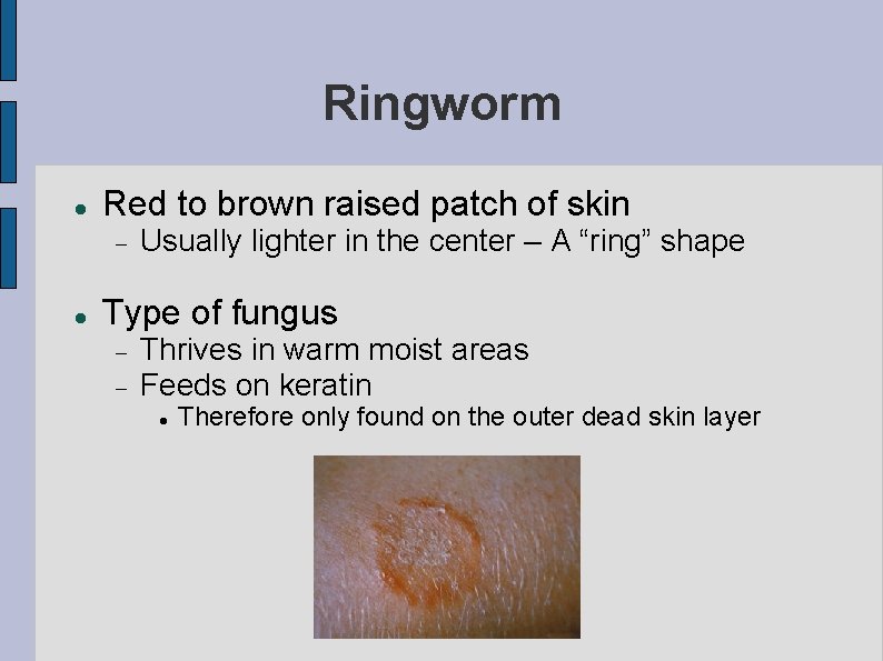 Ringworm Red to brown raised patch of skin Usually lighter in the center –