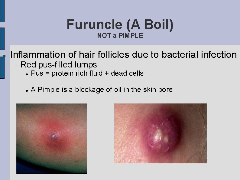 Furuncle (A Boil) NOT a PIMPLE Inflammation of hair follicles due to bacterial infection