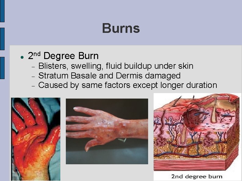 Burns 2 nd Degree Burn Blisters, swelling, fluid buildup under skin Stratum Basale and