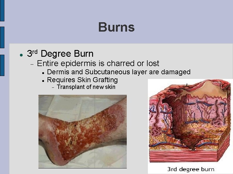 Burns 3 rd Degree Burn Entire epidermis is charred or lost Dermis and Subcutaneous