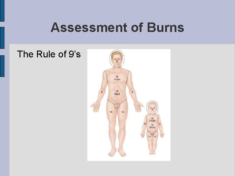 Assessment of Burns The Rule of 9’s 