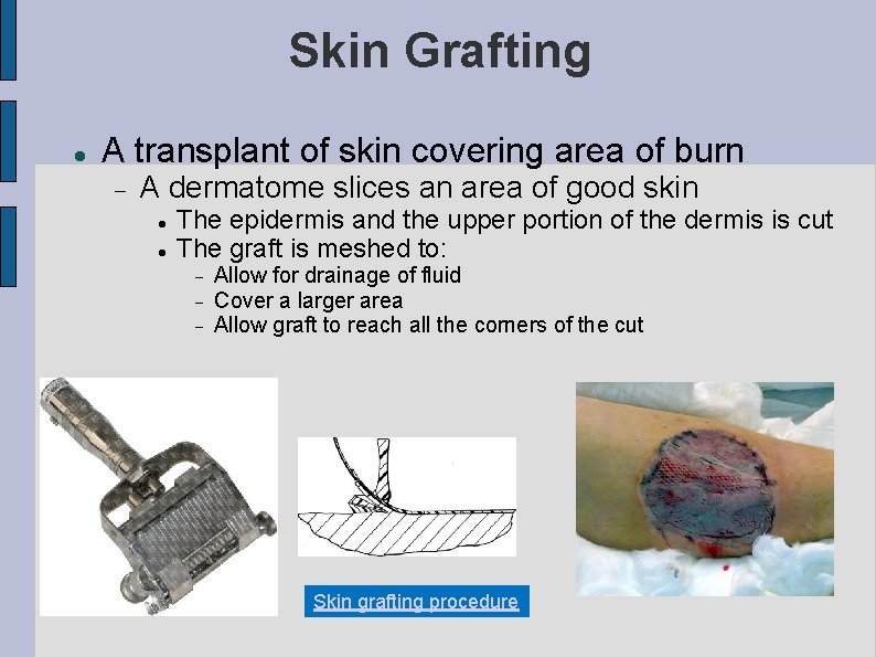 Skin Grafting A transplant of skin covering area of burn A dermatome slices an