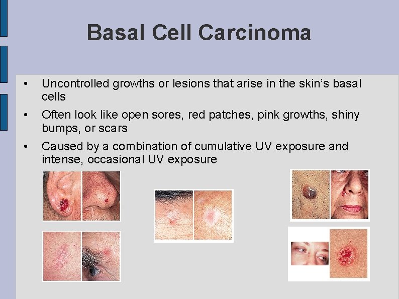 Basal Cell Carcinoma • • • Uncontrolled growths or lesions that arise in the