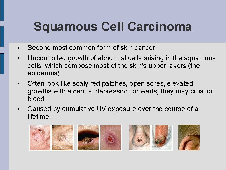 Squamous Cell Carcinoma • • Second most common form of skin cancer Uncontrolled growth