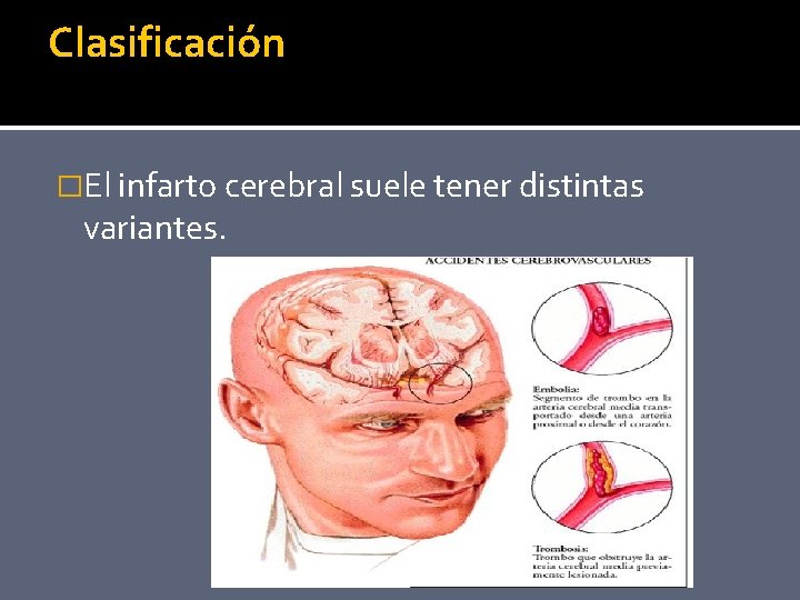 Clasificación �El infarto cerebral suele tener distintas variantes. 