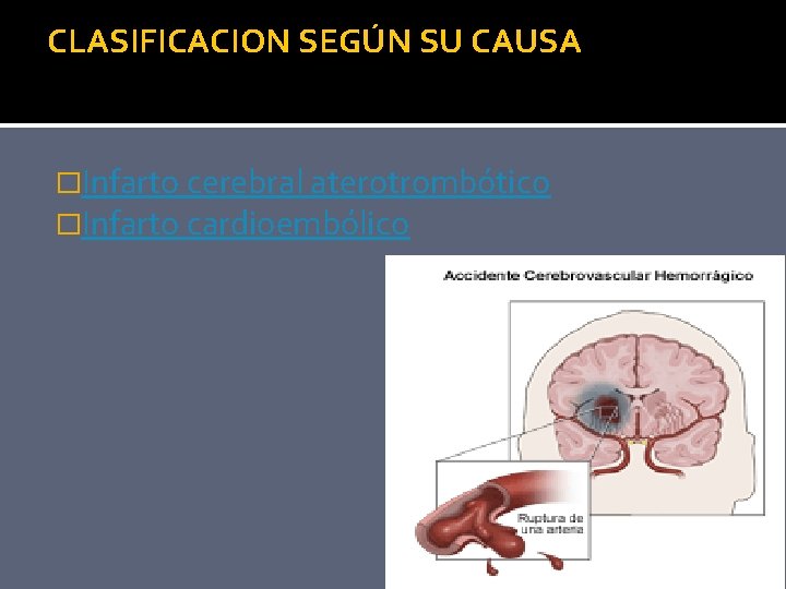 CLASIFICACION SEGÚN SU CAUSA �Infarto cerebral aterotrombótico �Infarto cardioembólico 