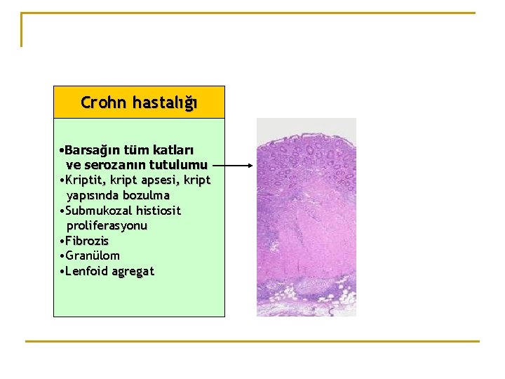 Crohn hastalığı • Barsağın tüm katları ve serozanın tutulumu • Kriptit, kript apsesi, kript