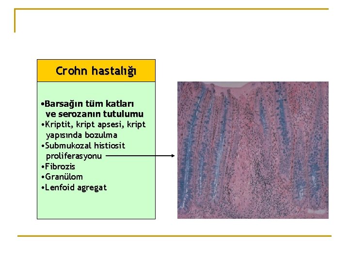 Crohn hastalığı • Barsağın tüm katları ve serozanın tutulumu • Kriptit, kript apsesi, kript