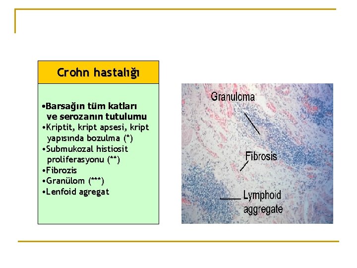 Crohn hastalığı • Barsağın tüm katları ve serozanın tutulumu • Kriptit, kript apsesi, kript