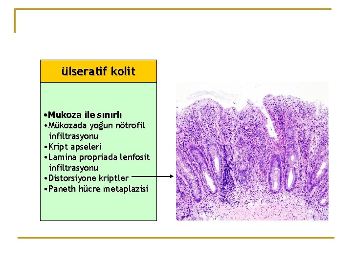 ülseratif kolit • Mukoza ile sınırlı • Mükozada yoğun nötrofil infiltrasyonu • Kript apseleri