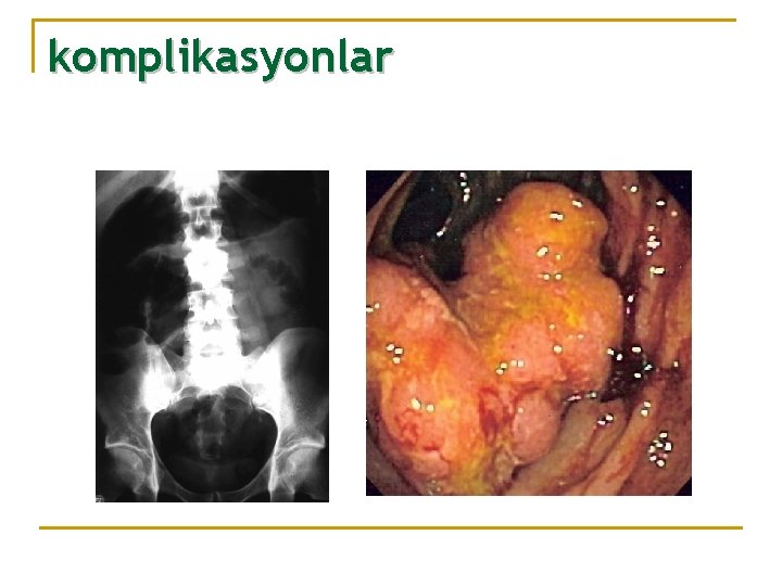 komplikasyonlar 