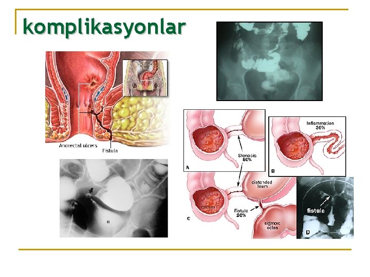 komplikasyonlar 