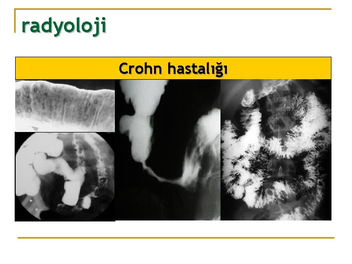 radyoloji Crohn hastalığı 