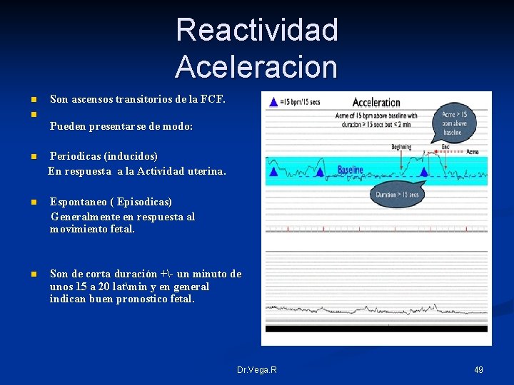 Reactividad Aceleracion n n Son ascensos transitorios de la FCF. Pueden presentarse de modo: