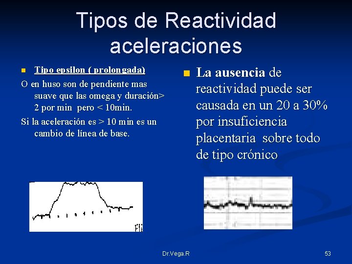 Tipos de Reactividad aceleraciones Tipo epsilon ( prolongada) O en huso son de pendiente