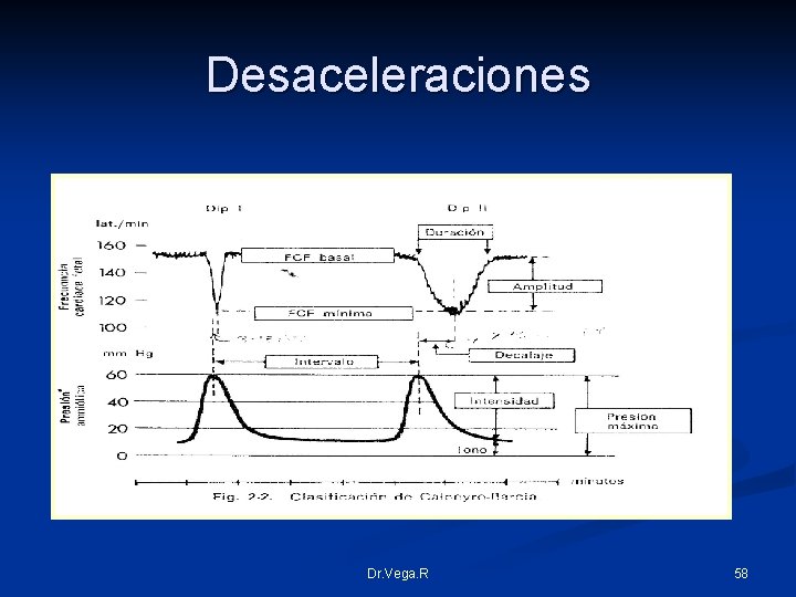 Desaceleraciones Dr. Vega. R 58 
