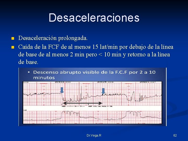 Desaceleraciones n n Desaceleración prolongada. Caída de la FCF de al menos 15 lat/min