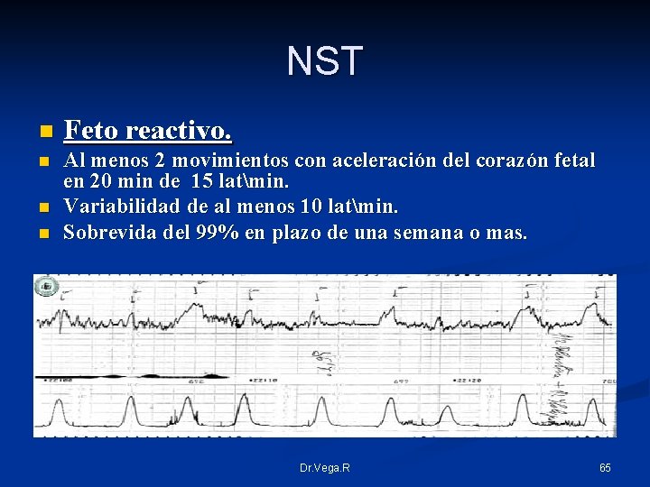 NST n Feto reactivo. n Al menos 2 movimientos con aceleración del corazón fetal