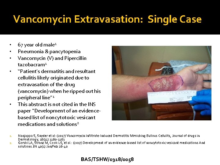 Vancomycin Extravasation: Single Case • • • 1. 2. 67 year old male 1