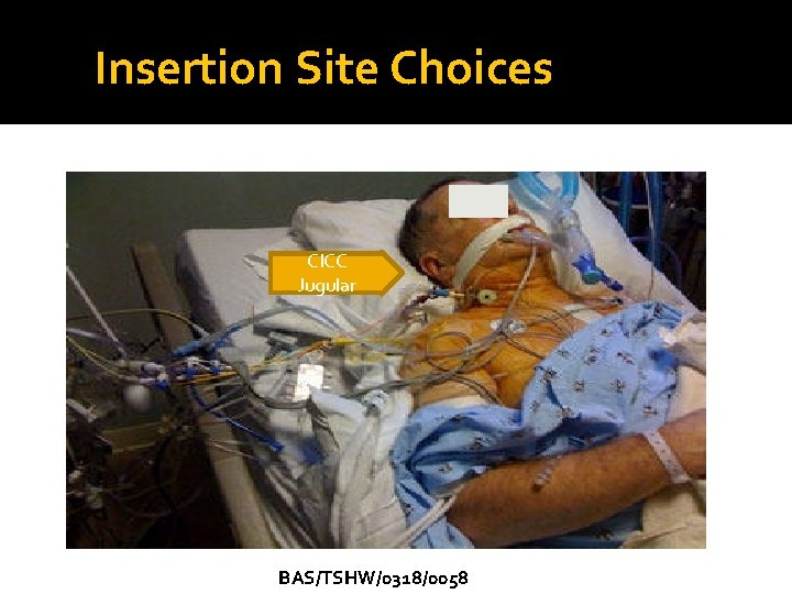 Insertion Site Choices CICC Jugular BAS/TSHW/0318/0058 